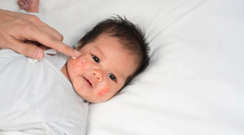 Skin rash in infants