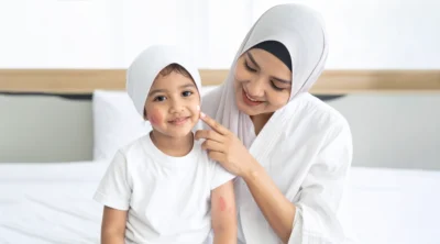 علاج إكزيما الأطفال